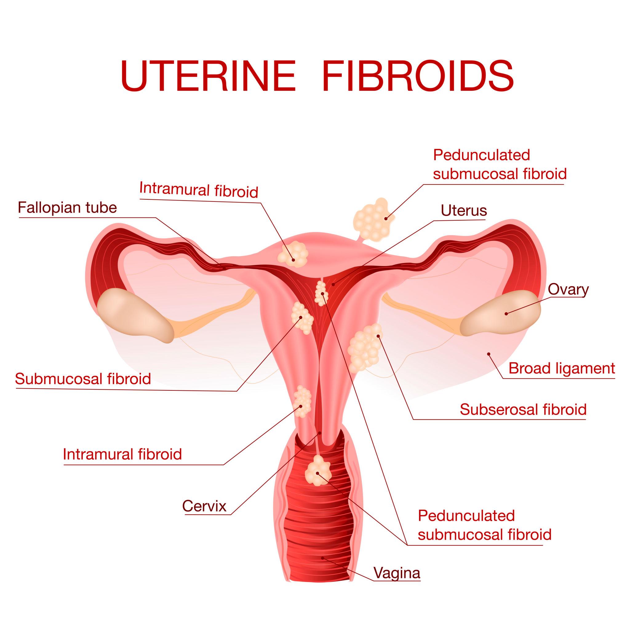 Laparoscopic Surgery for Large Fibroids in Pune – Advanced & Safe Treatment